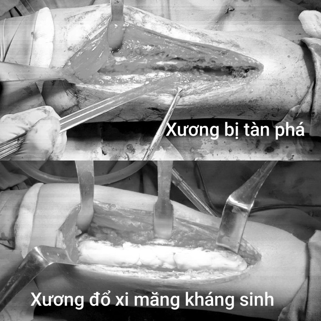 be-trai-11-tuoi-suyt-mat-mang-mat-chan-vi-tu-cau-vang-an-mon-xuong-dui-2