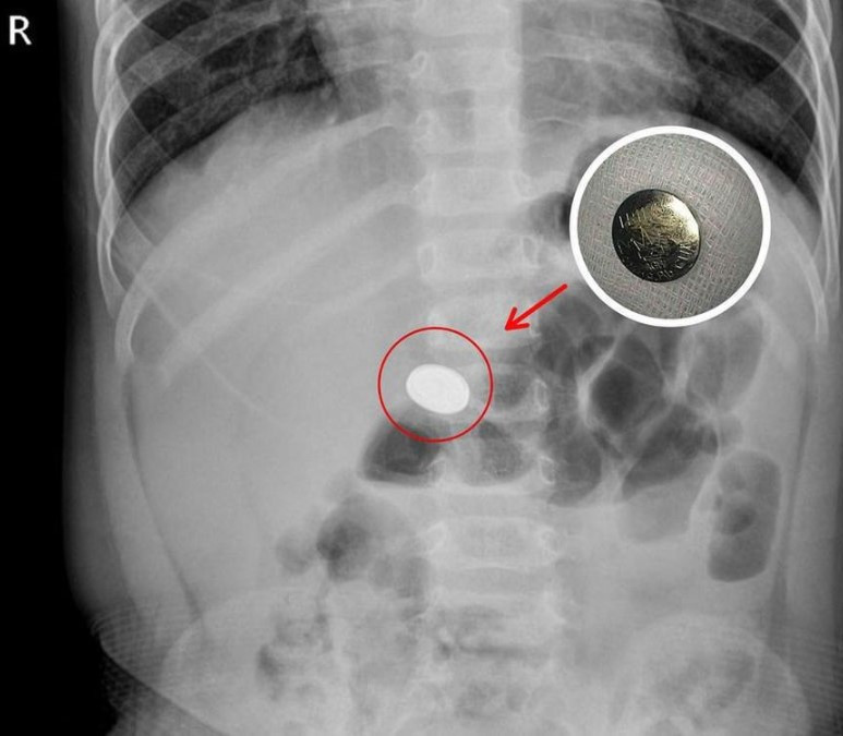 Hình ảnh dị vật pin cúc áo trong dạ dày của bé N.M.H (Ảnh: BVCC)