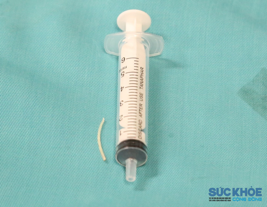 Mảnh xương cá được gắp ra khỏi cổ họng người bệnh (ảnh: TL)