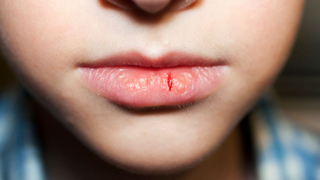 Môi bong tróc là dấu hiệu cơ thể thiếu vitamin A (Ảnh: Sưu tầm)