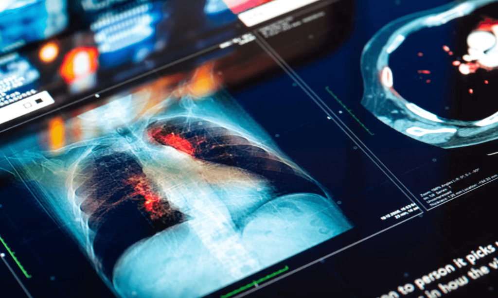 Hình ảnh chụp cộng hưởng từ (MRI) để chẩn đoán ung thư phổi (Ảnh: da-kuk/Getty Images)