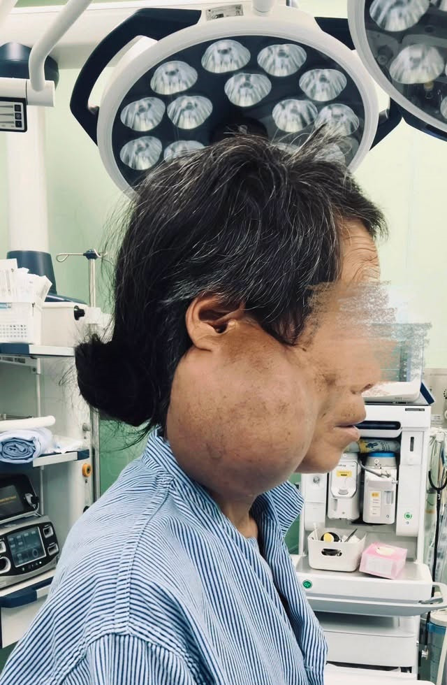 Bệnh nhân L và khối u khổng lồ ở tai (Ảnh: Bệnh viện K)