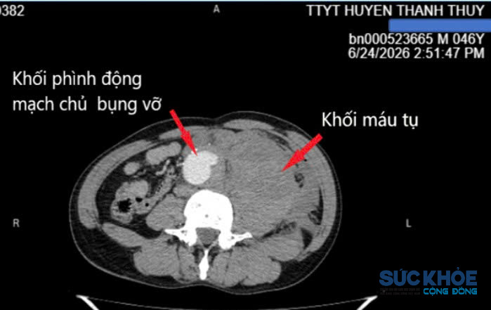 Hình ảnh phim chụp cho thấy khối máu tụ rất lớn ở khoang sau phúc mạc và phình động mạch chủ bụng (ảnh: TL)