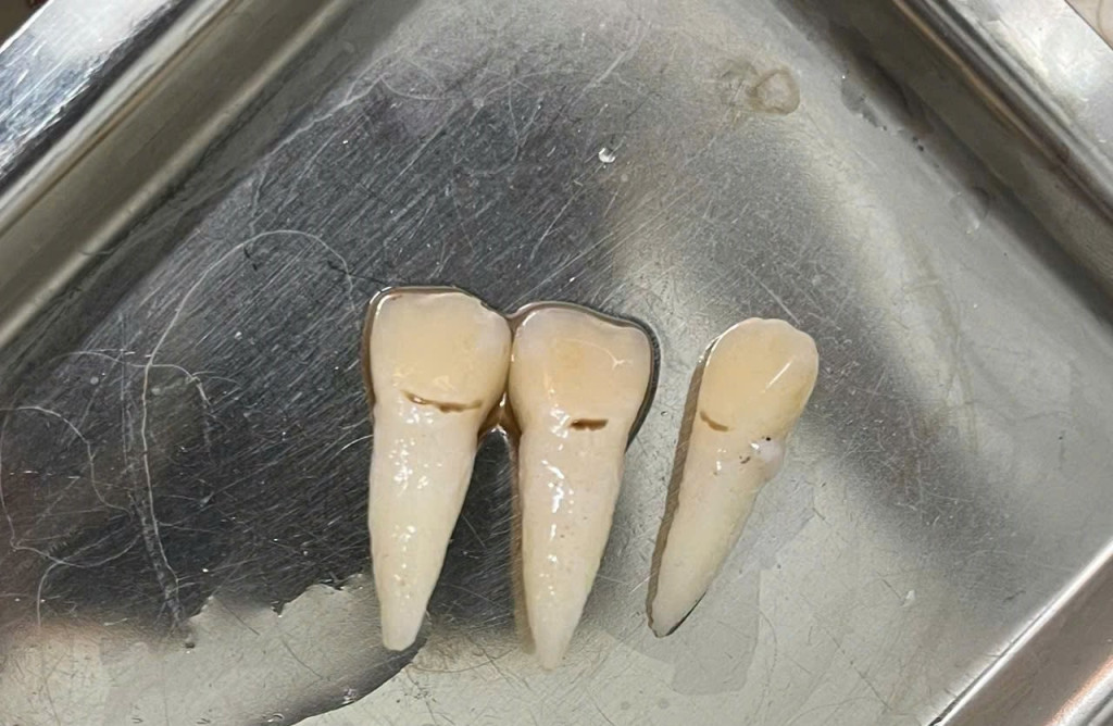 Răng của bệnh nhi (Ảnh: Trung tâm Y tế khu vực Chiêm Hoá)