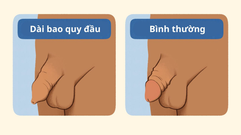 Bao quy đầu dài dễ bị viêm nhiễm (Ảnh: Sưu tầm)