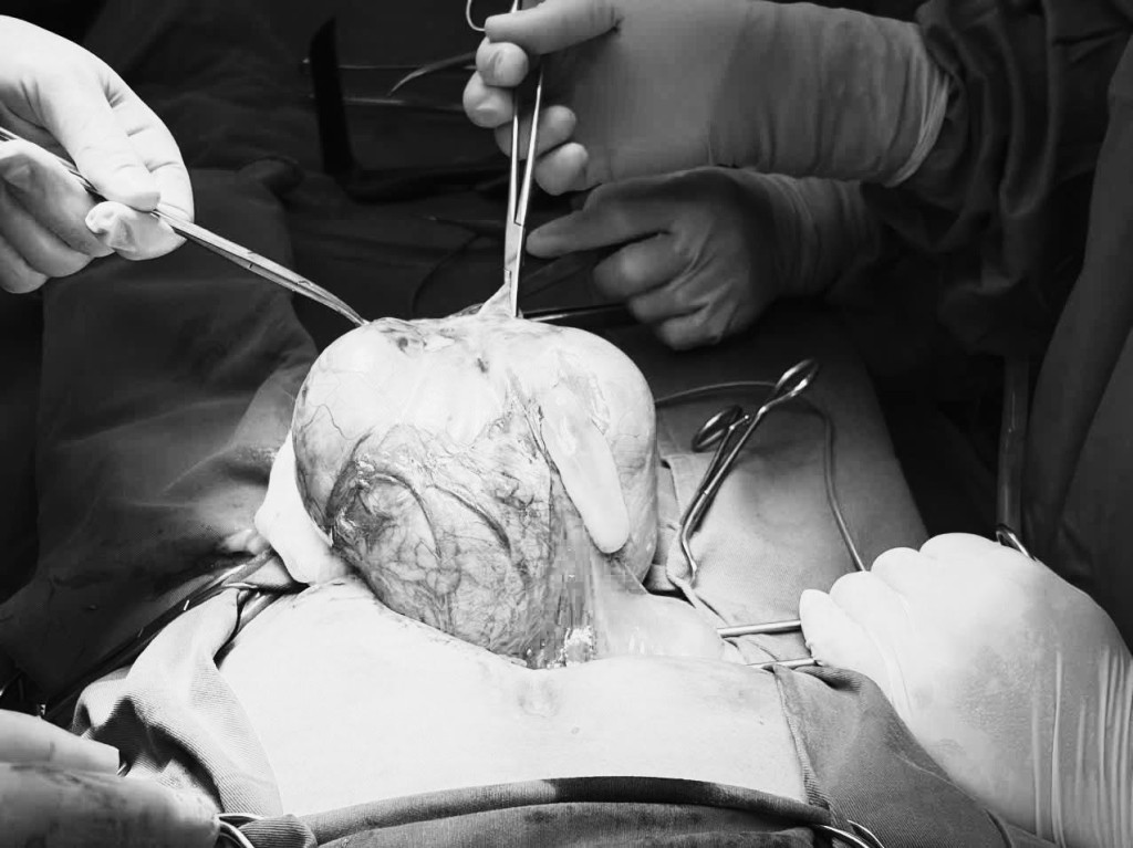 Hình ảnh khối u khổng lồ của bệnh nhân (Ảnh: Bệnh viện Đa khoa Hoè Nhai)