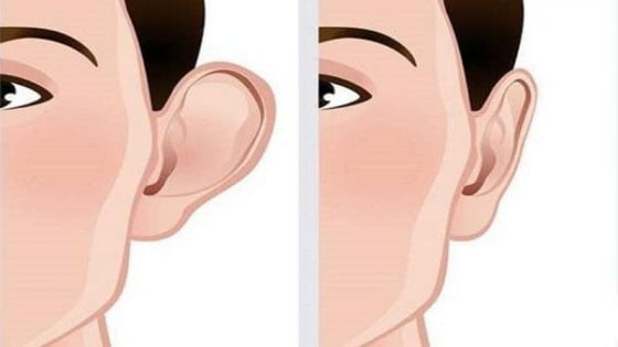 Phẫu thuật tai vểnh ở Việt Nam: Nhu cầu cao, rủi ro lớn