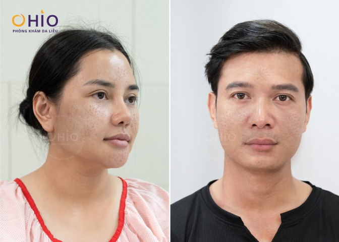 Trị sẹo rỗ có đau không? Trải nghiệm tổ hợp công nghệ Pulse Scar tại OHIO