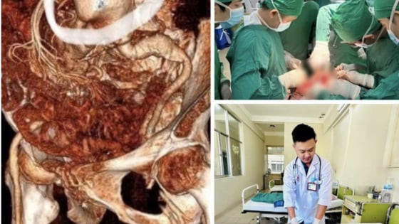 Phẫu thuật cứu sống cụ bà 86 tuổi bị vỡ phình động mạch chủ bụng