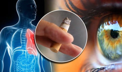 Người hút thuốc có nguy cơ bị các bệnh về mắt cao gấp nhiều lần so với bình thường