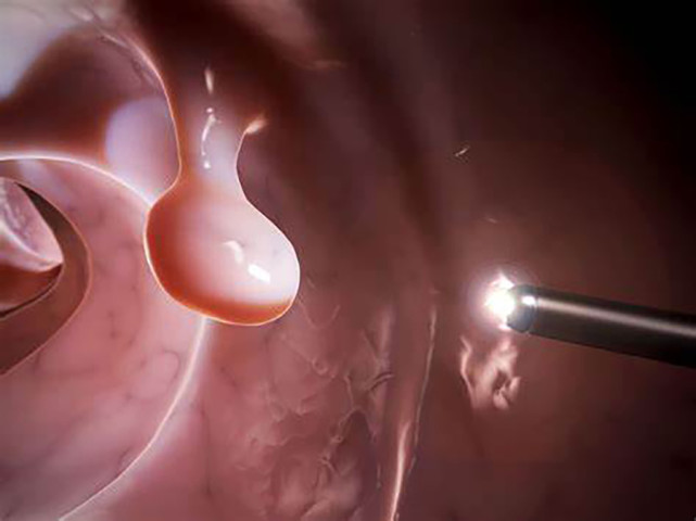 Cách điều trị polyp theo y học cổ truyền