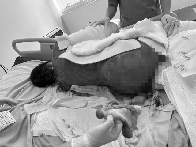 Cứu sống bệnh nhân tổn thương da 92% diện tích cơ thể do hội chứng hiếm gặp