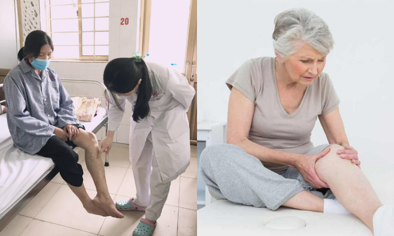 Bạn có nằm trong nhóm dễ bị suy giãn tĩnh mạch?