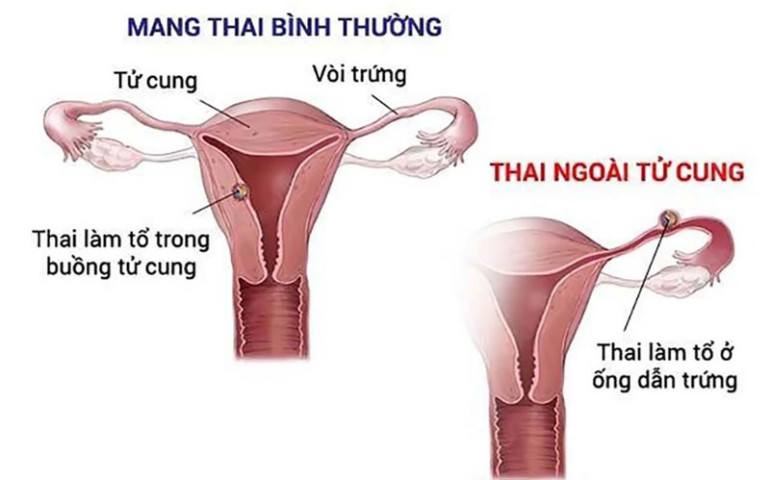 Sau sảy thai, cơ thể phụ nữ sẽ thay đổi ra sao?