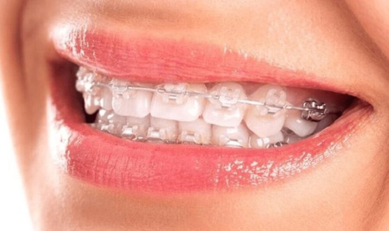 8 lưu ý quan trọng khi niềng răng bạn cần biết