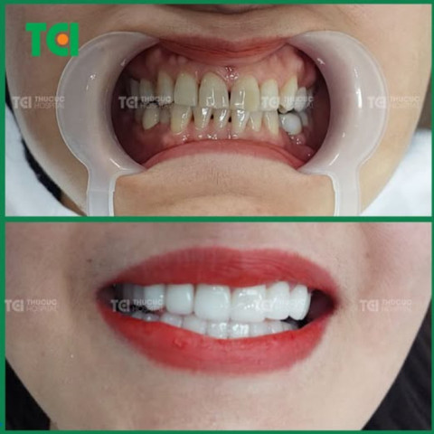 Lấy lại nụ cười tự tin với dịch vụ bọc răng sứ tại TCI