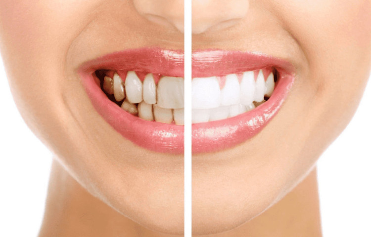 Những tác hại tiềm ẩn khi tẩy trắng răng sai cách