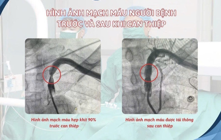 Hải Phòng: Bệnh viện Hữu nghị Việt Tiệp can thiệp thành công hội chứng “ăn cắp máu”, phục hồi tuần hoàn máu lên não cho bệnh nhân cao tuổi