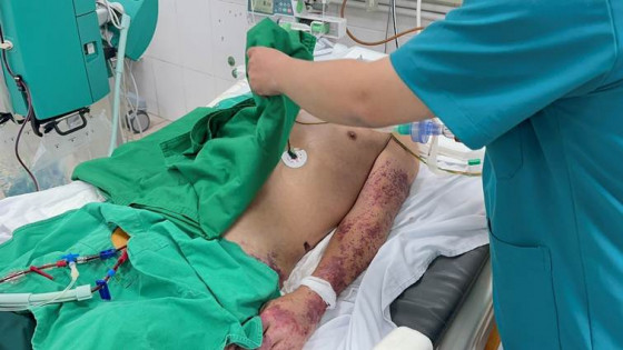 Bộ Y tế khuyến cáo 6 cách phòng, chống bệnh liên cầu lợn