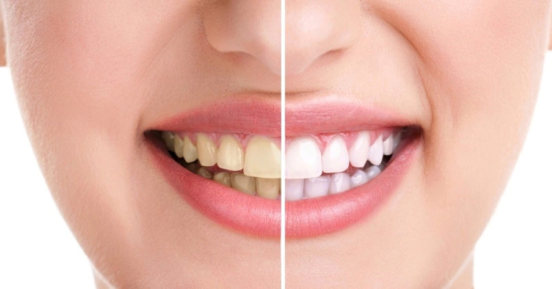Làm trắng răng tự nhiên với dầu dừa
