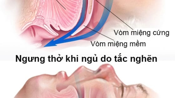 Đừng chủ quan với hội chứng ngừng thở khi ngủ