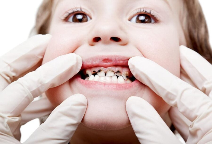 “Thủ phạm” bất ngờ gây sâu răng sữa ở trẻ