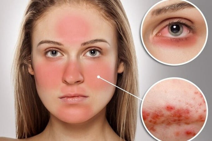 Làm sao để nhận diện và xử lý sớm bệnh tự miễn