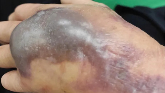 Bệnh viện Đa khoa thành phố Vinh điều trị thành công bệnh nhân bị sốc nhiễm khuẩn do mắc tụ cầu vàng