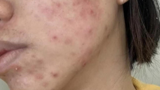 Bệnh nhân da liễu có xu hướng tăng vì sử dụng mỹ phẩm không rõ nguồn gốc