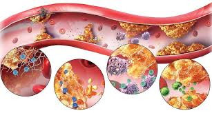 Trẻ hóa bệnh nhân mắc rối loạn mỡ máu