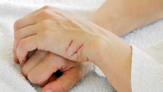 Tiên phong trong điều trị: Vật liệu sinh học Nga thúc đẩy chữa lành vết thương nhanh và hiệu quả