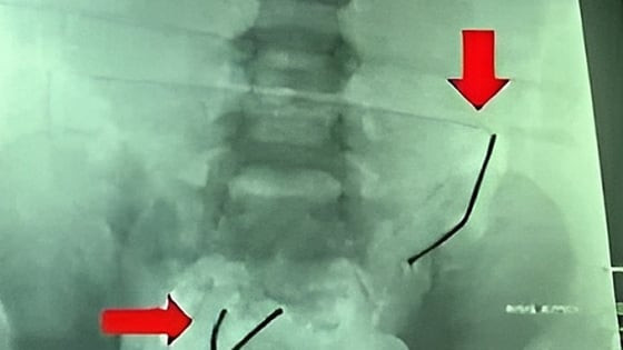Bé trai 5 tuổi thủng ruột 8 lỗ sau khi nuốt 20 viên nam châm: Lời cảnh tỉnh dành cho cha mẹ