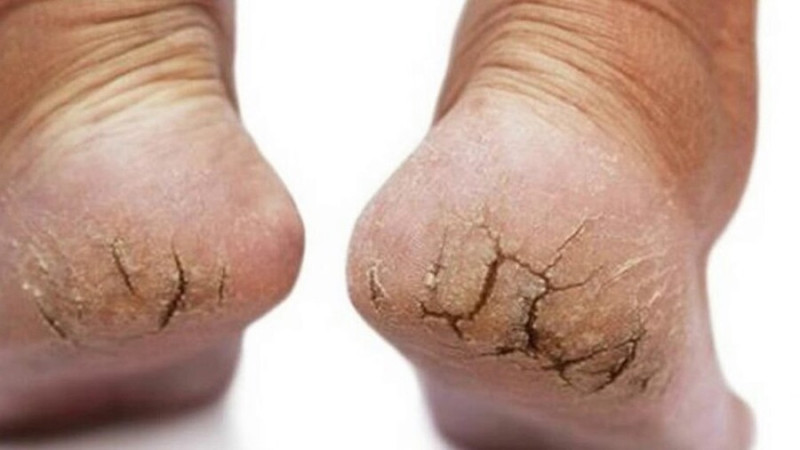 Cách chăm sóc gót chân nứt nẻ trong mùa lạnh