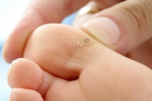 Mụn cóc và mụn rộp sinh dục khác nhau thế nào?
