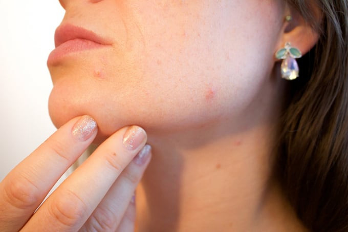 8 biện pháp khắc phục tại nhà mụn nang thực sự hiệu quả