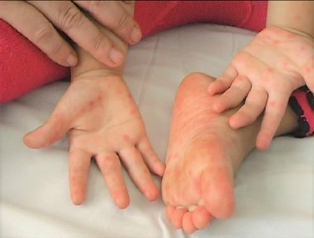 Những bệnh trẻ em dễ mắc phải mùa thu đông và cách phòng tránh