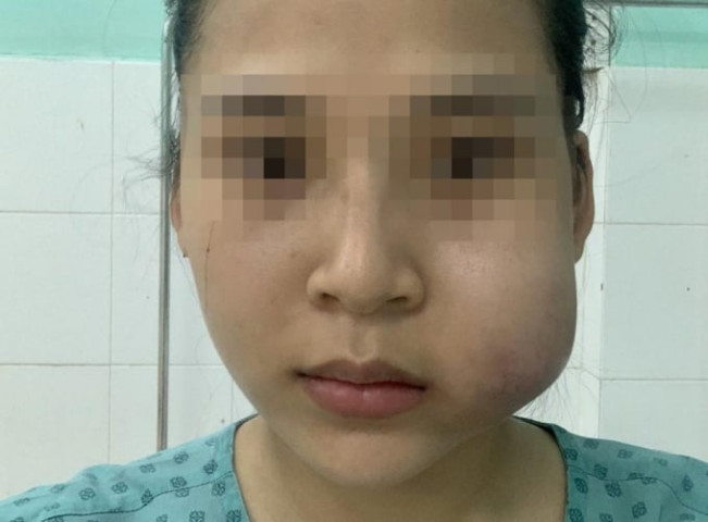 Cô gái 23 tuổi bị nhiễm trùng vùng má trái sau khi tiêm filler
