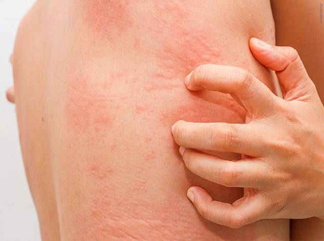Nguyên nhân, triệu chứng của bệnh nổi mề đay khi trời lạnh