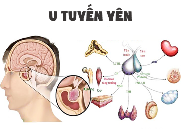 Một số lưu ý quan trọng về bệnh u tuyến yên