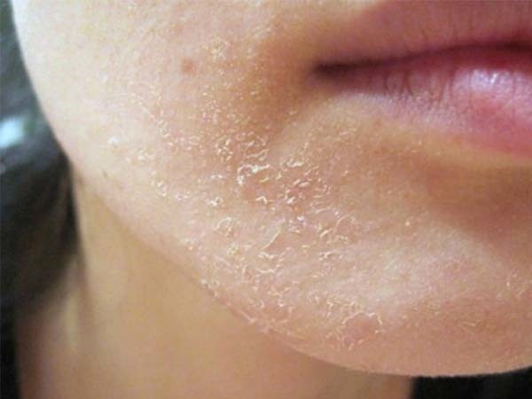 Cơ thể bạn sẽ bị ảnh hưởng ra sao vào mùa đông?
