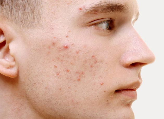Triệu chứng, nguyên nhân và cách điều trị mụn trứng cá