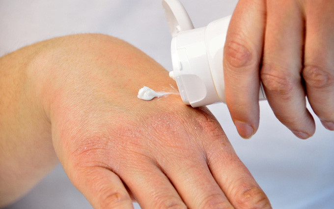 Nguyên nhân, triệu chứng, yếu tố rủi ro và cách điều trị bệnh phát ban mùa đông