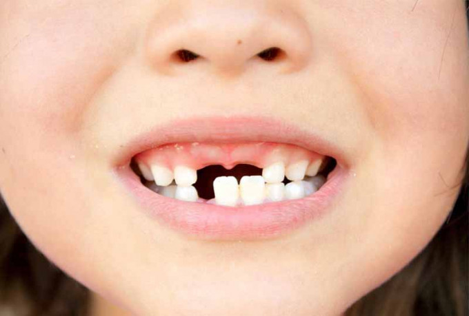Nguyên nhân gây nên tình trạng sún răng của trẻ