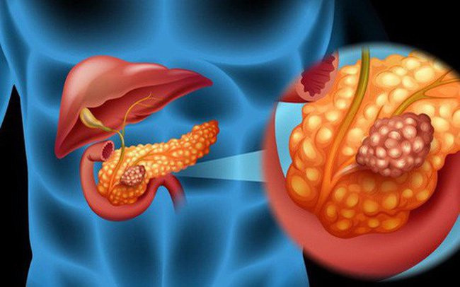 Ung thư tụy xếp thứ 6 trong các loại ung thư đường tiêu hóa