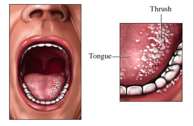 Những điều cần biết về căn bệnh nấm đường tiêu hóa
