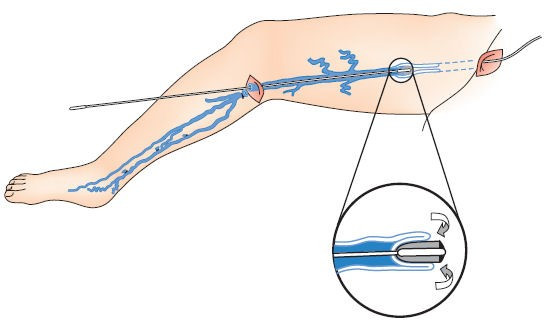 Những dấu hiệu để nhận biết bệnh suy giãn tĩnh mạch chi dưới