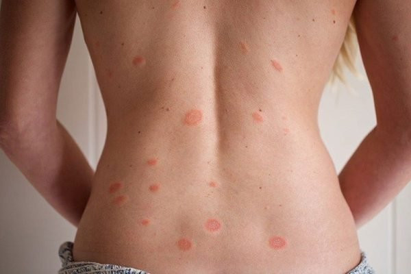 Nguyên nhân và triệu chứng của bệnh vẩy phấn hồng