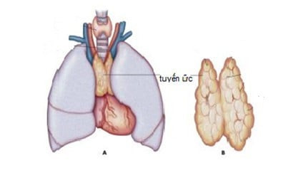 Bệnh lý nhược cơ có liên quan đến bất thường của tuyến ức