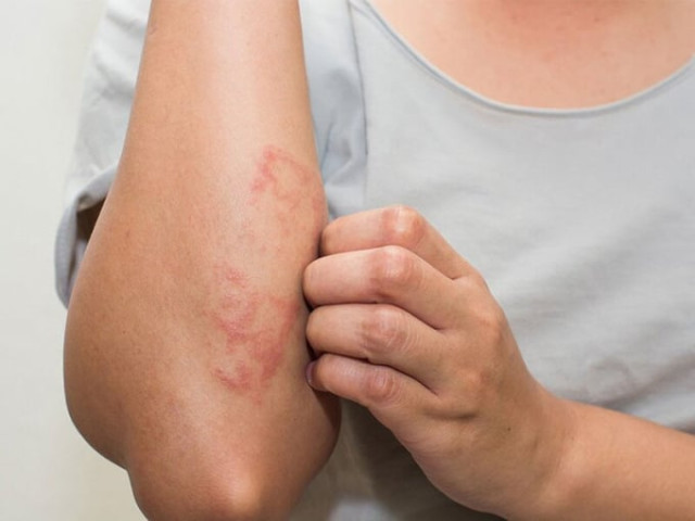 Nhiễm trùng da có thể dẫn đến sốt thấp khớp