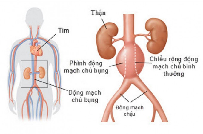 Phình động mạch chủ có tỷ lệ tử vong rất cao
